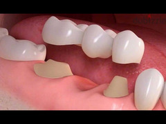 تركيبات اسنان - 1